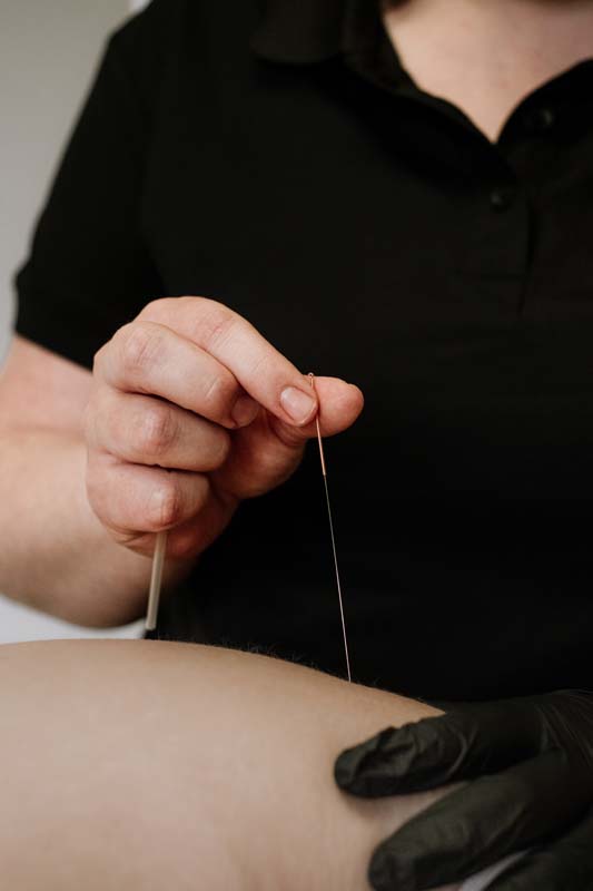 Dry Needling
